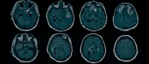 Source of hidden consciousness in ‘comatose’ brain injury patients found