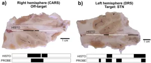 Spectroscopy probe could enhance deep brain stimulation procedure for Parkinson’s