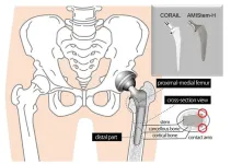Staying hip to orthopedic advances: Comparing traditional and new hip replacement stems