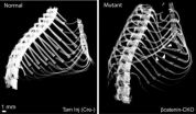 Steroids help reverse rapid bone loss tied to rib fractures