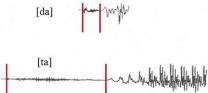 Strengthening speech networks to treat aphasia