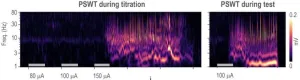 Study assesses seizure risk from stimulating thalamus