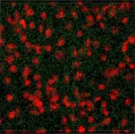 Study finds abnormal response to cellular stress is associated with Huntingtons disease