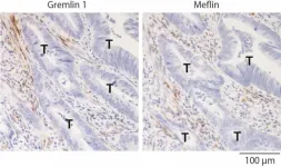 Study finds potential therapeutic targets to inhibit colorectal cancer progression