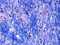 Study finds surprising way that genetic mutation causes Huntington’s disease, transforming understanding of the disorder