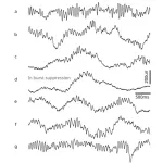 Study finds tracking brain waves could reduce post-op complications