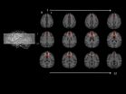 Study links delay of gratification to how brain structures are connected