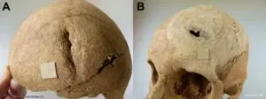 Study reveals isolation, endogamy and pathogens in early medieval Spanish community 3