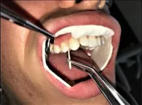 Study reveals new aspects of gingivitis and bodys response