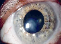 Study reveals untapped potential to increase eye donations needed for sight-restoring surgeries