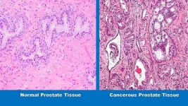 Study suggests a healthy diet may help keep low grade prostate cancer from progressing to more dangerous states during active surveillance