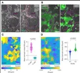 Study: suppressing key protein may unlock immunotherapy for Glioblastoma 2