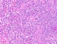 Study: Whole genome sequencing provides unprecedented detail on the genetic evolution of Hodgkin lymphoma