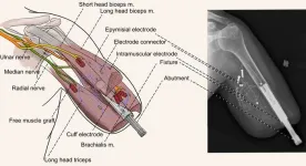 Surgical and engineering innovations enable unprecedented control over every finger of a bionic hand