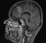 Surgical treatment of brain tumors should also be considered for the elderly