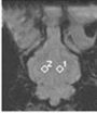 SWI assesses signal strength in different brain regions after acute hemorrhagic anemia