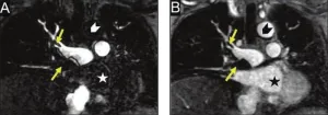 Switch to MR angiography for PE mitigated impact of recent contrast shortage