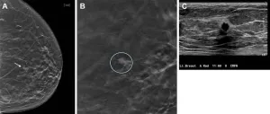 Ten-year study shows tomosynthesis improves breast cancer detection