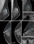 Ten-year study shows tomosynthesis improves breast cancer detection 2