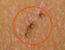 Test for persistent Lyme infection using live ticks shown safe in clinical study 2