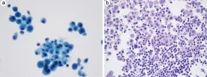 The International System for reporting serous fluid cytopathology—an updated review