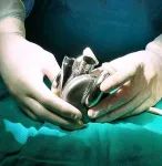 The Texas Heart Institute implants BiVACOR® Total Artificial Heart 2