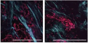 Therapeutic resistance linked to softer tissue environment in breast cancer