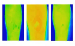 Thermal imaging offers early alert for chronic wound care