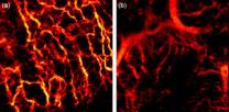 Tissues tell the tale: Non-invasive optical technique detects cancer by looking under the skin