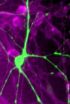 Too much protein may kill brain cells as Parkinsons progresses