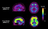 Tracing the impact of amyloid beta in mild cognitive impairment