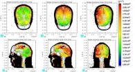 Traumatic brain injury patients, supercomputer simulations studied to improve helmets