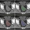 Tumor-analysis technology enables speedier treatment decisions for bowel-cancer patients