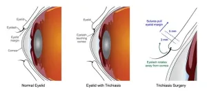 Two common surgeries equally effective for treating blinding condition of the eyelid