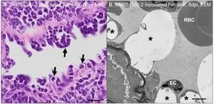 Two new studies identify promising pathways to treat chronic COVID-19 2