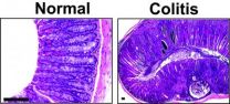 UCLA-led study identifies genetic factors involved in pediatric ulcerative colitis