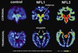 UCLA study first to image concussion-related abnormal brain proteins in retired NFL players 