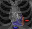 UCLA uses new hybrid, precision heart procedures to help stop deadly arrhythmias