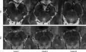 Ultra-high-field MRI may allow earlier diagnosis of Parkinsons disease