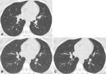 Ultra-low dose CT aids pneumonia diagnosis in immunocompromised patients