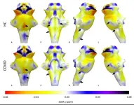 Ultra-powered MRI scans show damage to brain’s ‘control center’ is behind long-lasting Covid-19 symptoms