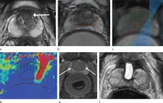 Ultrasound technique treats prostate cancer with minimal side effects