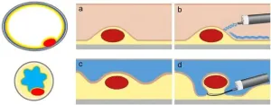 Underwater resection of neuroendocrine tumors of the gastrointestinal tract