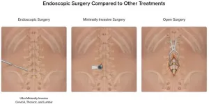 University Hospitals now offering ultra-minimally invasive endoscopic spine surgery for patients experiencing back pain