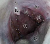 Using low-cost videoscopes to obtain accurate video “oral selfies” as screening for hpv-associated oropharyngeal cancer: a new screening technology?