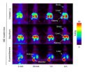 Using PET scanning to evaluate therapies of Menkes disease 2