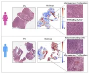 UW–Madison researchers use AI to identify sex-specific risks associated with brain tumors