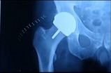 Walkup Law Office Says the DePuy ASR Hip Implant Cup Failed Long Before Expected and Advertised 2