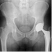 Walkup Law Office Says the DePuy ASR Hip Implant Cup Failed Long Before Expected and Advertised 3