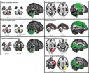 Wii Balance Board induces changes in the brains of MS patients 2